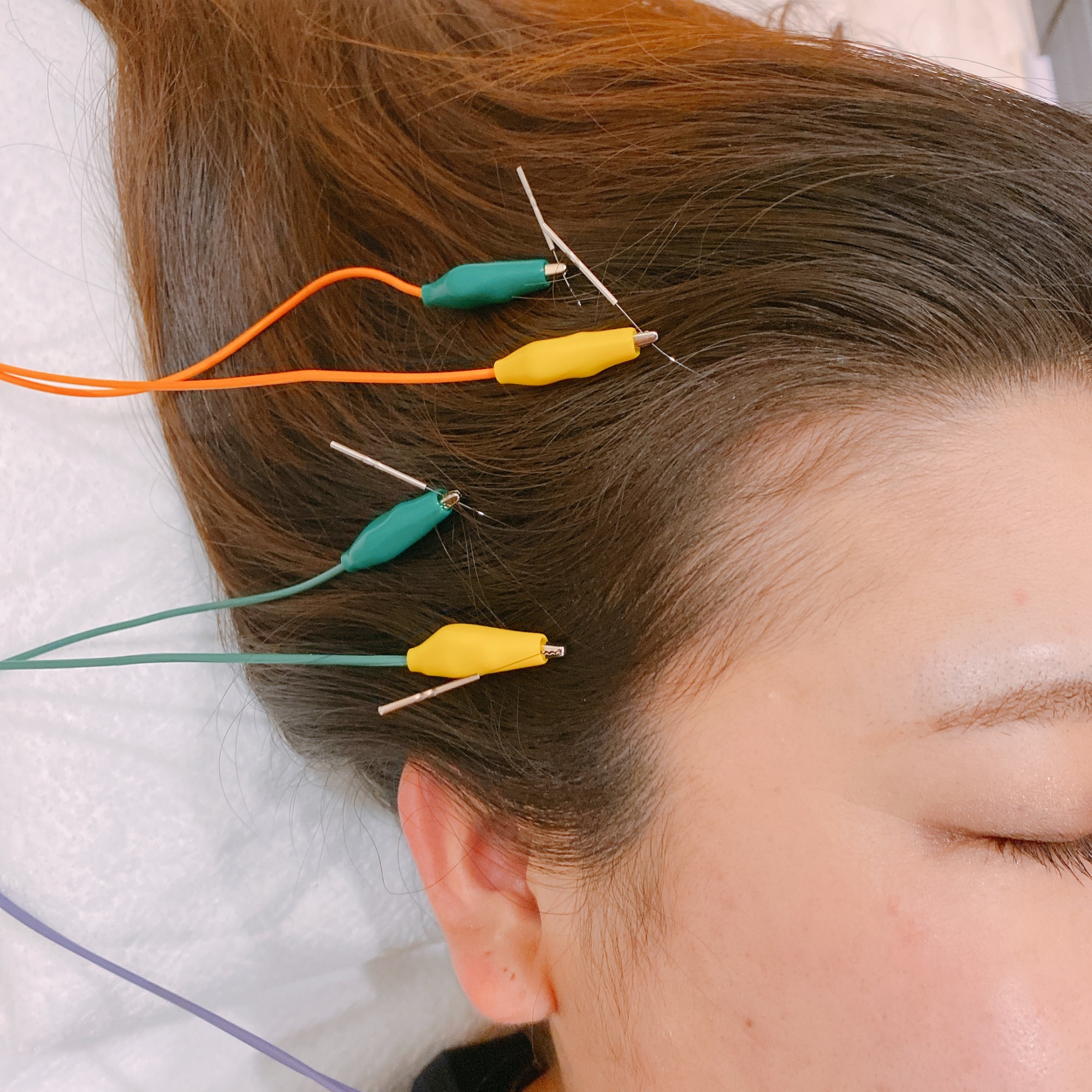 美容鍼に電気を流す！美容パルスの効果やデメリットは？ - 神戸三宮 